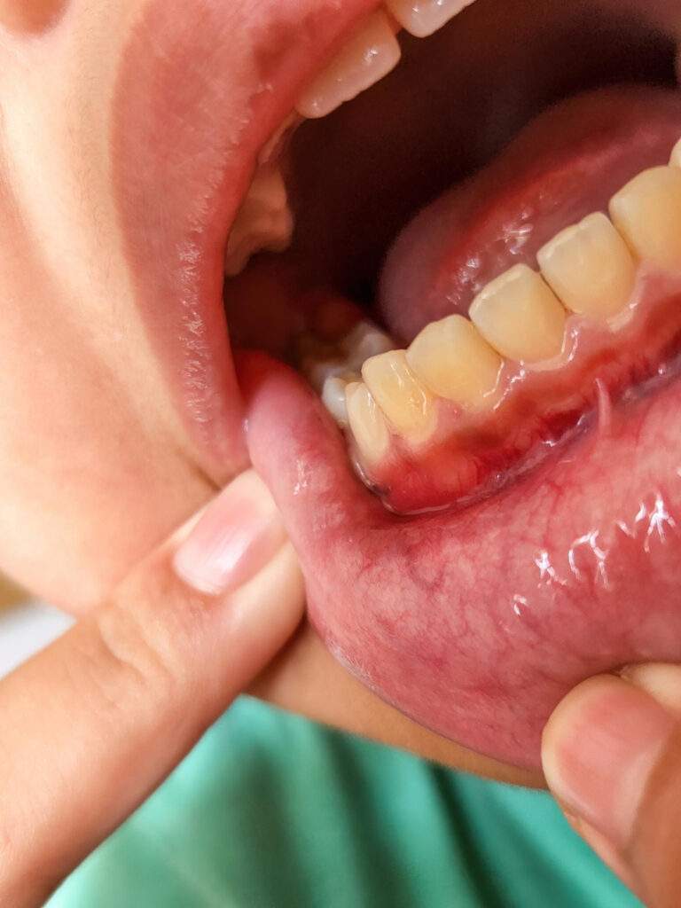 Periodoncia en Abadiño